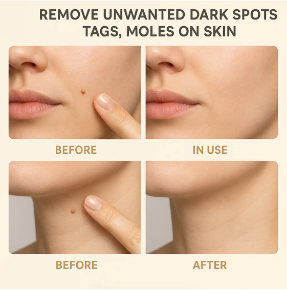 Organic Skin Tag Remover Serum - All Natural For Warts